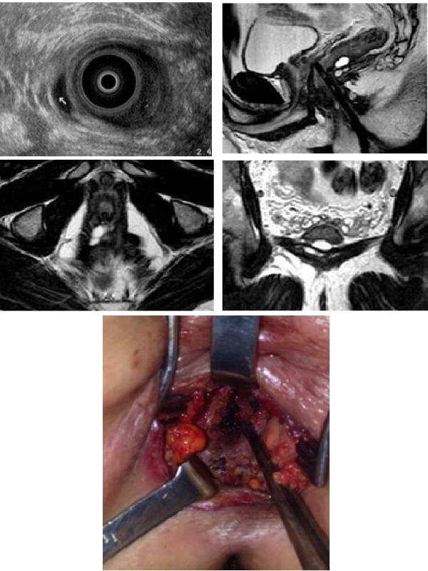 Evaluation of Recurrent and/or Persistent Complex Ano-Perianal Abscess after Surgery: The Unique Value of Magnetic Resonance (MR) Imaging