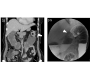 Apple-core Lesion of Colon Adenocarcinoma by Barium Double Contrast Enema
