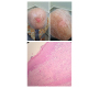 Erozive Pustular Dermatosis of Scalp: An Overlooked Entity
