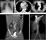Aortic Dissection Presenting with Atypical Chest Pain