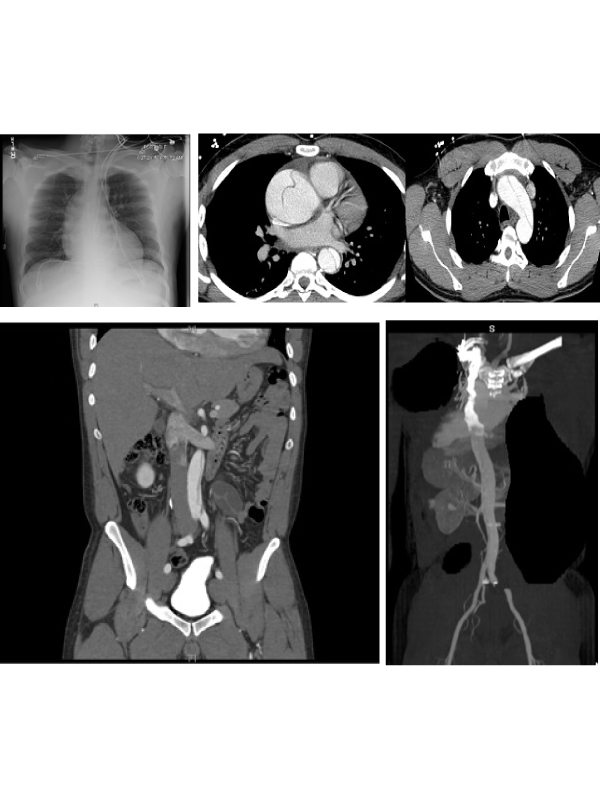 Aortic Dissection Presenting with Atypical Chest Pain