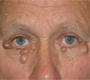 Bilateral Peri-Orbital Skin Lesions