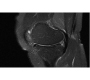 Cost-effectiveness Analysis of the Diagnosis of Meniscus Tears