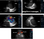 Sonographic Images of a Massive Abdominal Aortic Aneurysm with Contiguous Supra and Infrarenal Involvement