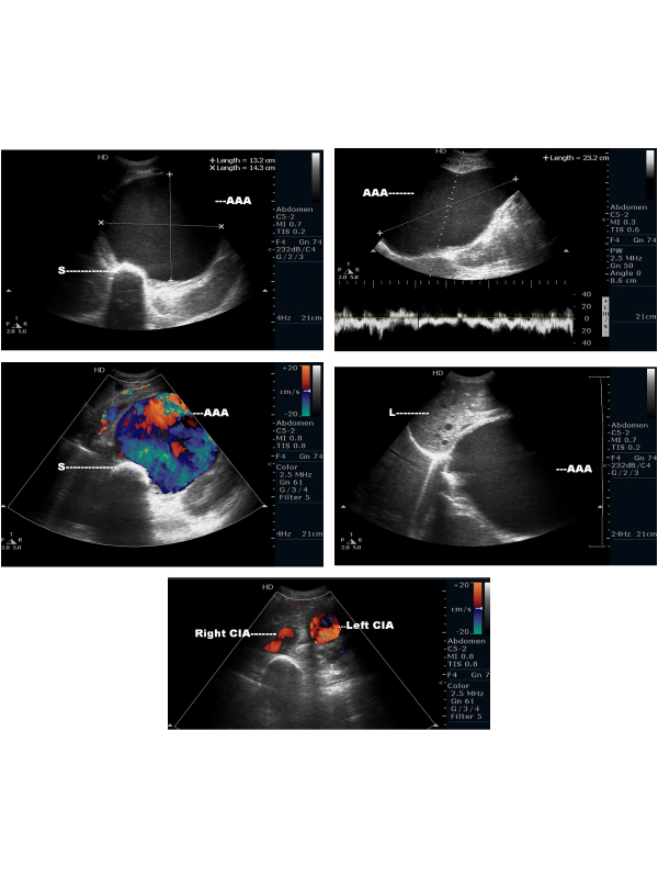 Sonographic Images of a Massive Abdominal Aortic Aneurysm with Contiguous Supra and Infrarenal Involvement