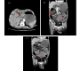 Traumatic Pneumatosis Intestinalis