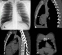 Stress Fracture of the Sternum in Case Dealing With the Wrestling Sport