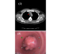 Near Obstructing Tracheal Lipoma
