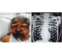 Subcutaneous Emphysema