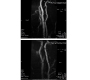 Infective Endocarditis Causing Complete Occlusion of Internal Carotid Artery and Presenting as Acute Ischemic Stroke
