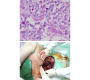 Fatal Primary Cutaneous Cryptococcosis