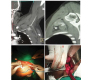 Post Stab Injury Subclavin Artery Pseudoaneurysm Excision