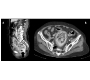 Stercoral Colitis