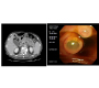 Intraductal Papillary Mucinous Neoplasm (IPMN) of Pancreas in Elderly Patient
