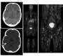 Cysticercosis-A Pictorial Review