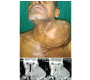 A Rare Presentation of Papillary Thyroid Carcinoma
