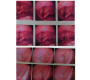 A Recurrent Case of Spindle Cell Variant of Squamous Cell Carcinoma