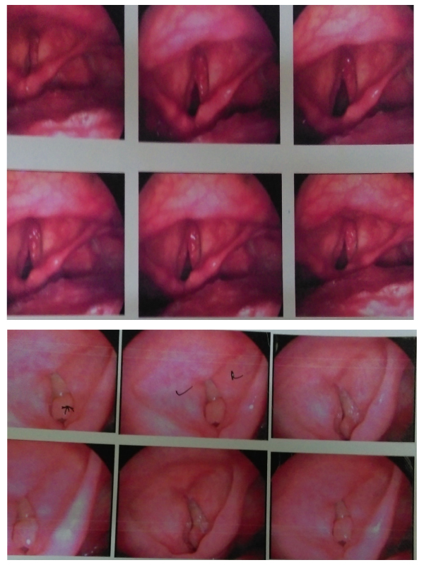 A Recurrent Case of Spindle Cell Variant of Squamous Cell Carcinoma