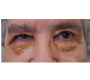 Necrobiotic Xanthogranuloma in a Patient with Multiple Myeloma