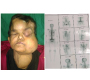 Follicular Carcinoma of Thyroid with Bone Metastasis