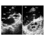 Lutembacherï¿½s Syndrome with Right Heart Failure-echocardiographic Findings
