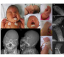 Apert Syndrome: Molecularly Confirmed C.758C>G (P.Pro253Arg) in FGFR2
