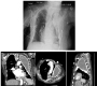 Fibrothorax as a Sequlae of Induced Pneumothoraces