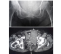 Massive Intrapelvic Hematoma after a Pubic Ramus Fracture in an Osteoporotic Patient