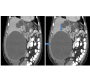 Polycystic Liver Disease