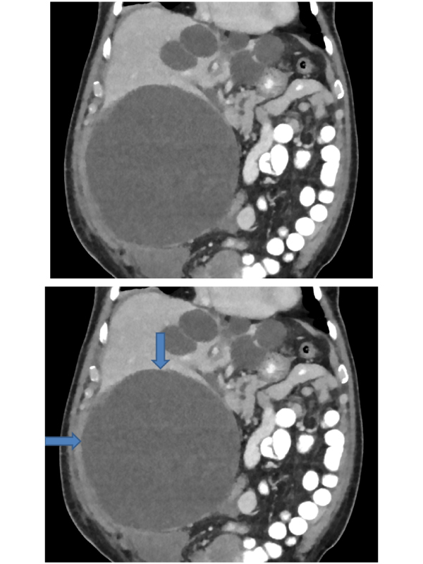 Polycystic Liver Disease