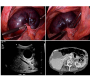 Gallbladder Volvulus: A Rare Emergent Cause of Acute Cholecystitis, if Untreated, Progresses to Necrosis and Perforation
