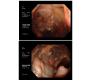 A Rare Presentation of Dilated Colonic Varices