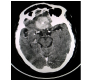 Planum Spheroidale Meningioma