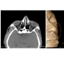 Alkali Chemical Burn with Placement of Morgan Lens