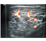 Sonographic Picture of Sjï¿½grenï¿½s Syndrome
