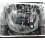 Zoledronic Acid Induced Osteonecrosis of the Jaw