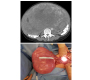 Leiomyosarcoma of Uterus