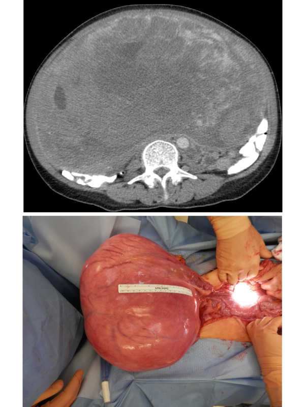 Leiomyosarcoma of Uterus