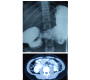 Unusual Cause of Gastric Outlet Obstruction