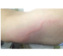 A Case of Cutaneous Larva Migrans in Turkish Patient