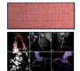 Anomalous Origin of the Right Coronary Artery with Inter-Aorto-Pulmonary Course Highlighted by ECG-gated Cardiac CT Angiography