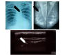 Mammary Artery Calcification a Useful Marker for Coronary Artery Disease