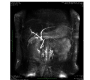 Isolated Left Hepatic Duct Drainage into the Duodenum - First MRCP Report