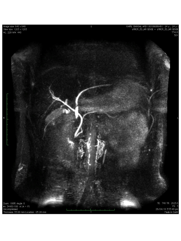 Isolated Left Hepatic Duct Drainage into the Duodenum - First MRCP Report