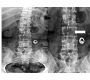 Winking-owl Sign - An Uncommon Presentation of Spine Metastasis