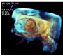 Loose-Flapping Left Atrial Myxoma Fragment Identified on 3D- Echocardiography