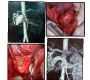 Surgical Management of a Superior Mesenteric Artery Aneurysm Resulting from Neurofibromatosis Type I