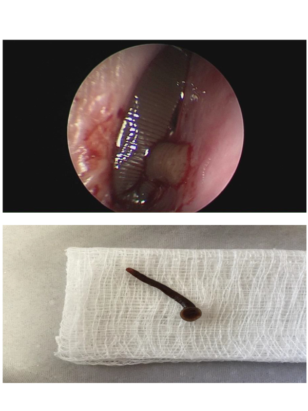 Unusual Presentation of a Leech in the Nose