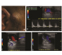 Ultrasound-Guided Temporal Artery Pseudoaneurysm Repair with Thrombin Injection