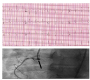 Variant Angina